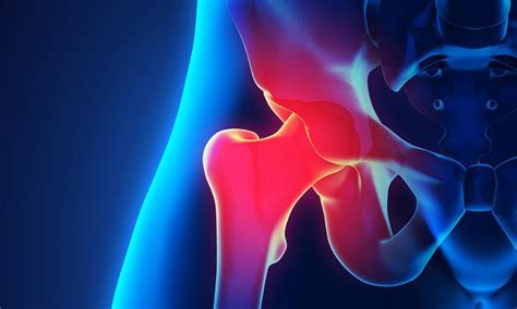 Hip Dislocation 101: Powell Orthopedics and Sports Medicine: Orthopedic Surgery