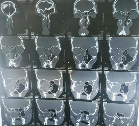 CT scan of nose and paranasal sinuses, showing pansinusitis right side... | Download Scientific ...