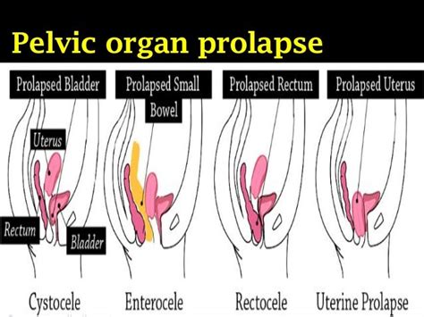 Mesh in Pelvic Organ Prolapse