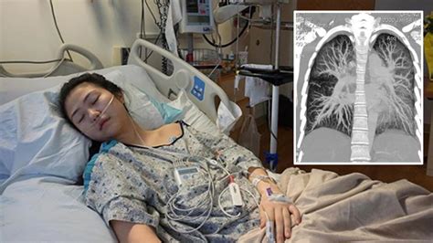 Photos of Maryland teen's lungs show effects of vaping