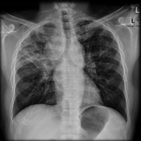 Interstitial lung disease causes, symptoms, stages, diagnosis & treatment