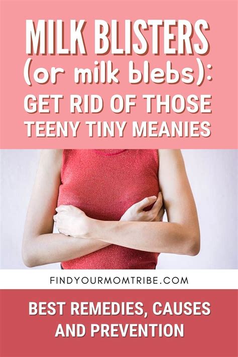 Milk blister 11 best remedies plus causes and prevention – Artofit