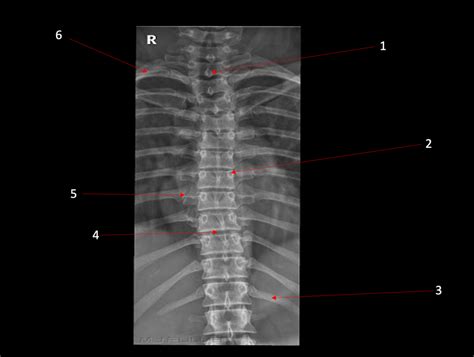 Diagram of AP thoracic spine Xray | Quizlet