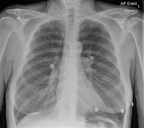 Calcified granuloma definition, causes, symptoms, diagnosis & treatment