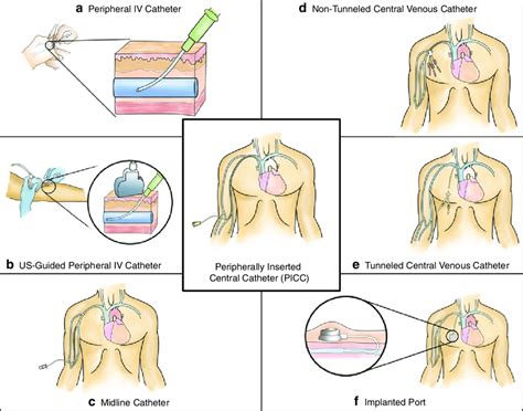 1 Types of venous access devices (Chopra et al. 2015). IV intravenous ...