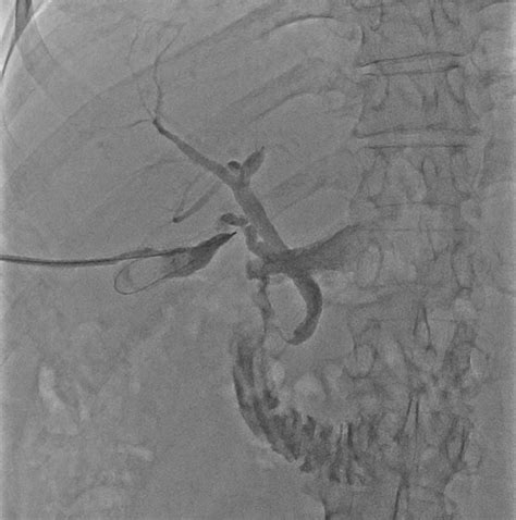 Figure 1 from Percutaneous Cholecystostomy as an Alternative to Cholecystectomy in High-Risk ...