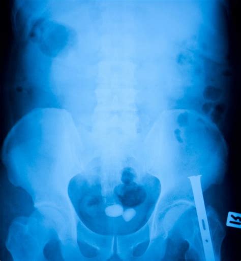 Bladder Stones: Causes, Symptoms, and Treatments