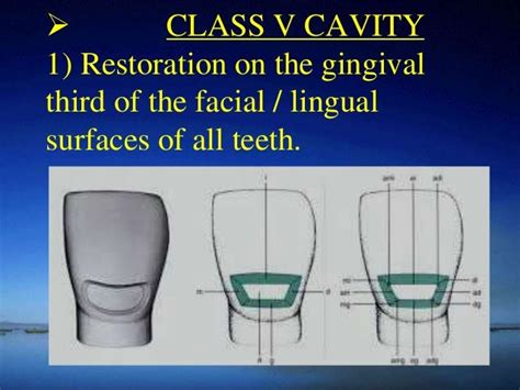 class 5 cavity