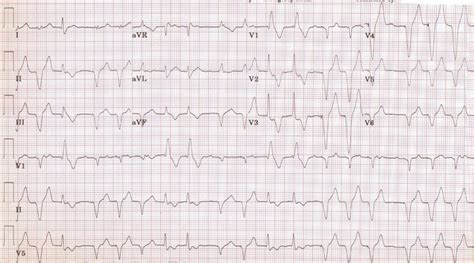 Multifocal atrial tachycardia - wikidoc