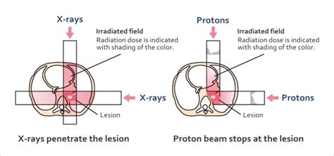 Differences between Radiation Therapy and Proton Therapy - Asian ...