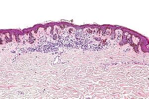 Dysplastic nevus - Libre Pathology