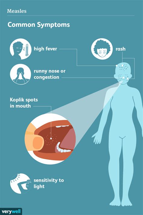 Measles Symptoms And Treatment