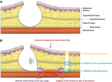 Schematic diagram of the keystone-design perforator island flap (KDPIF ...