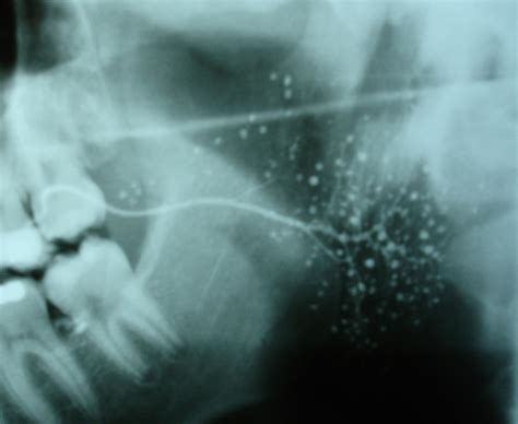 Sialography displaying the punctate pattern of sialectasis in an ICRP... | Download Scientific ...