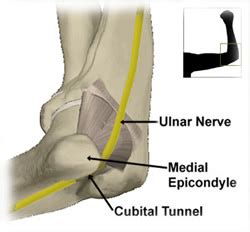 Cubital Tunnel Syndrome » Lillian S. Wells Department of Neurosurgery ...