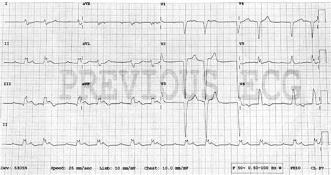 Sgarbossa Criteria • LITFL • ECG Library Diagnosis