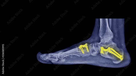 Film X-ray foot radiograph show Flat foot deformity (pes planus or fallen arches). Treatment by ...