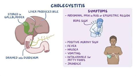 Symptoms of cholecystitis - MEDizzy