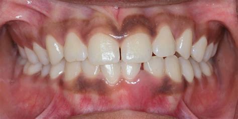 Treatment of Localized Aggressive Periodontitis | March 2020 | Inside Dentistry