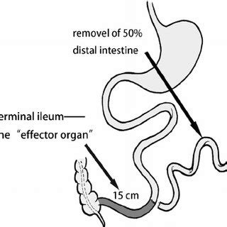 (PDF) Mid to Distal Small Bowel Resection with the Preservation of the ...