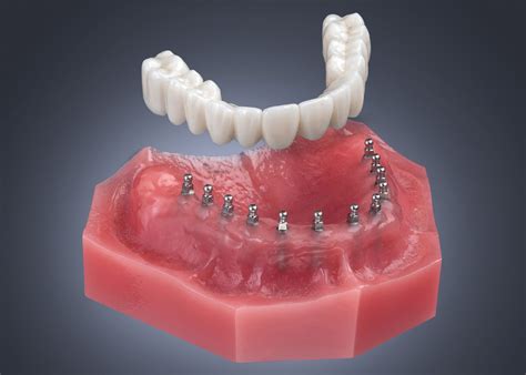 Mini Dental Implant Solutions | North Huntingdon, PA | Keystone Mini Dental Implant Center