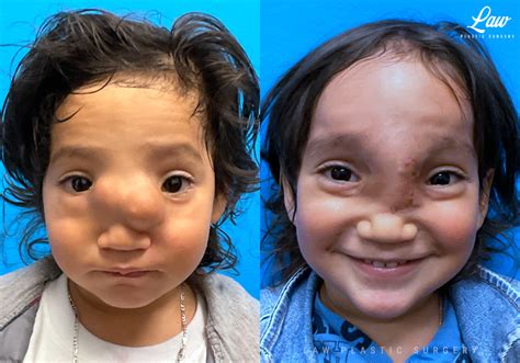 Craniofacial Reconstruction Before & After Photos - Sage Plastic Surgery