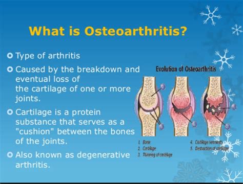 Everything you need to know about osteoarthritis - Morelia Medical Clinic