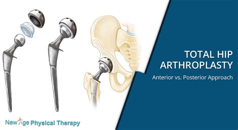 Total Hip Arthroplasty – Anterior vs. Posterior Approach - New Age ...