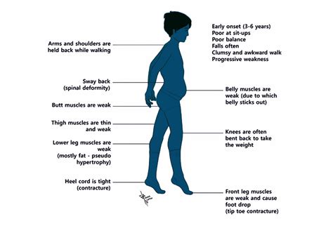 Myopathies: Muscling Your Way to the Diagnosis