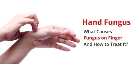 Fungus on Fingers (Hand Fungus): Causes, Symptoms, Treatments