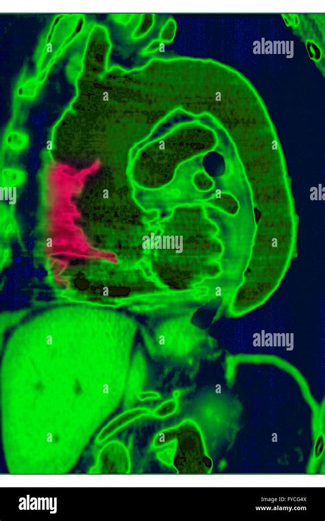 AORTIC DISSECTION, MRI Stock Photo - Alamy