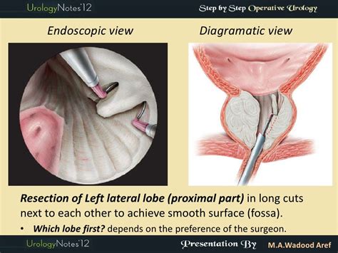 TURP step by step operative urology