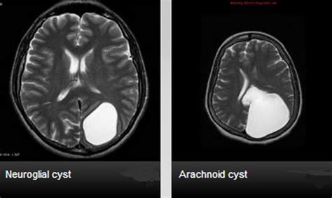 Porencephaly Cyst | Definition, Symptoms, Radiology (MRI) and Treatment