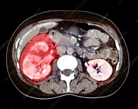 Kidney damage, CT scan - Stock Image - M195/0200 - Science Photo Library