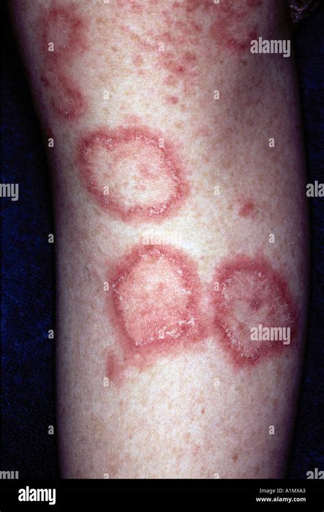 lupus skin rash Stock Photo: 3361442 - Alamy