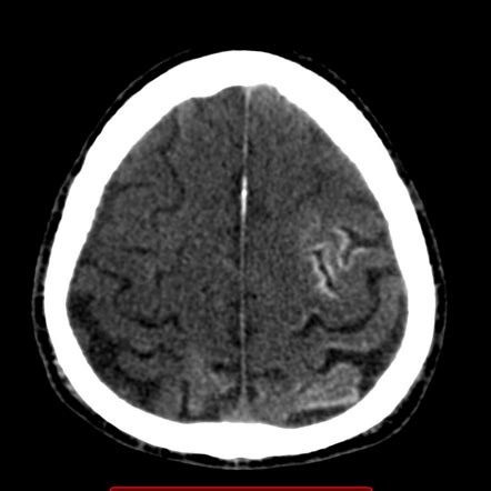 Tomba Dittatura capsula cortical laminar necrosis Grande universo Gelido Costa