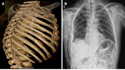 Surgical treatment ofpatients with severe non-flail chest rib fractures