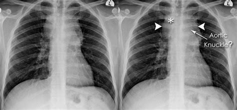 Chest X-ray Abnormalities - Mediastinal abnormalities