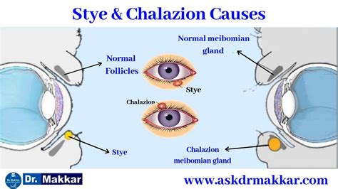 Stye,Chalazion, Causes, Symptoms, Stye Vs Chalazion,Non Surgical Approach,Through Homeopathic ...