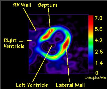 Nuclear Medicine Scan Heart