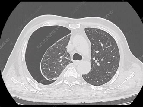 Pneumothorax, CT scan - Stock Video Clip - K011/0196 - Science Photo Library