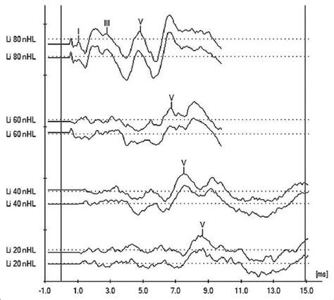 Corrected peaks of auditory brainstem response waveforms for the left ear | Download Scientific ...