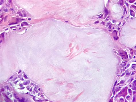 Tophus Histology