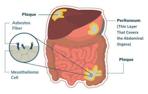 Peritoneal Mesothelioma | Treatment, Prognosis & Diagnosis