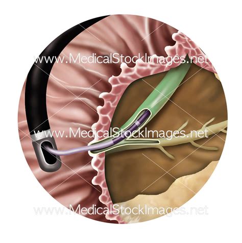 Endoscopic Retrograde Cholangiopancreatography or ERCP – Medical Stock Images Company