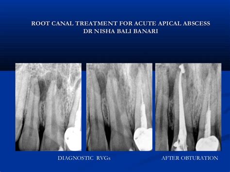 Acute Apical Abscess Radiograph