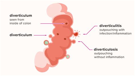 Diverticulosis Sigmoid Colon