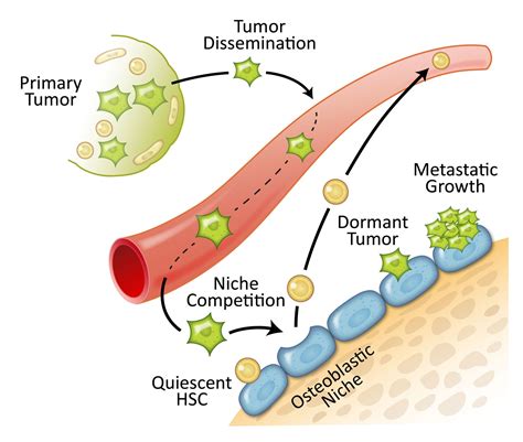 Prostate Cancer Spreads to Bones by Overtaking the Home of Blood Stem Cells