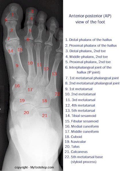 X-ray of the foot anterior-posterior view | MyFootShop.com