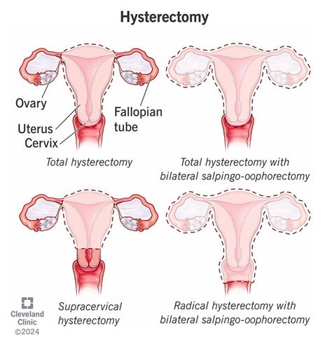 Benefits Of Hysterectomy For Fibroids